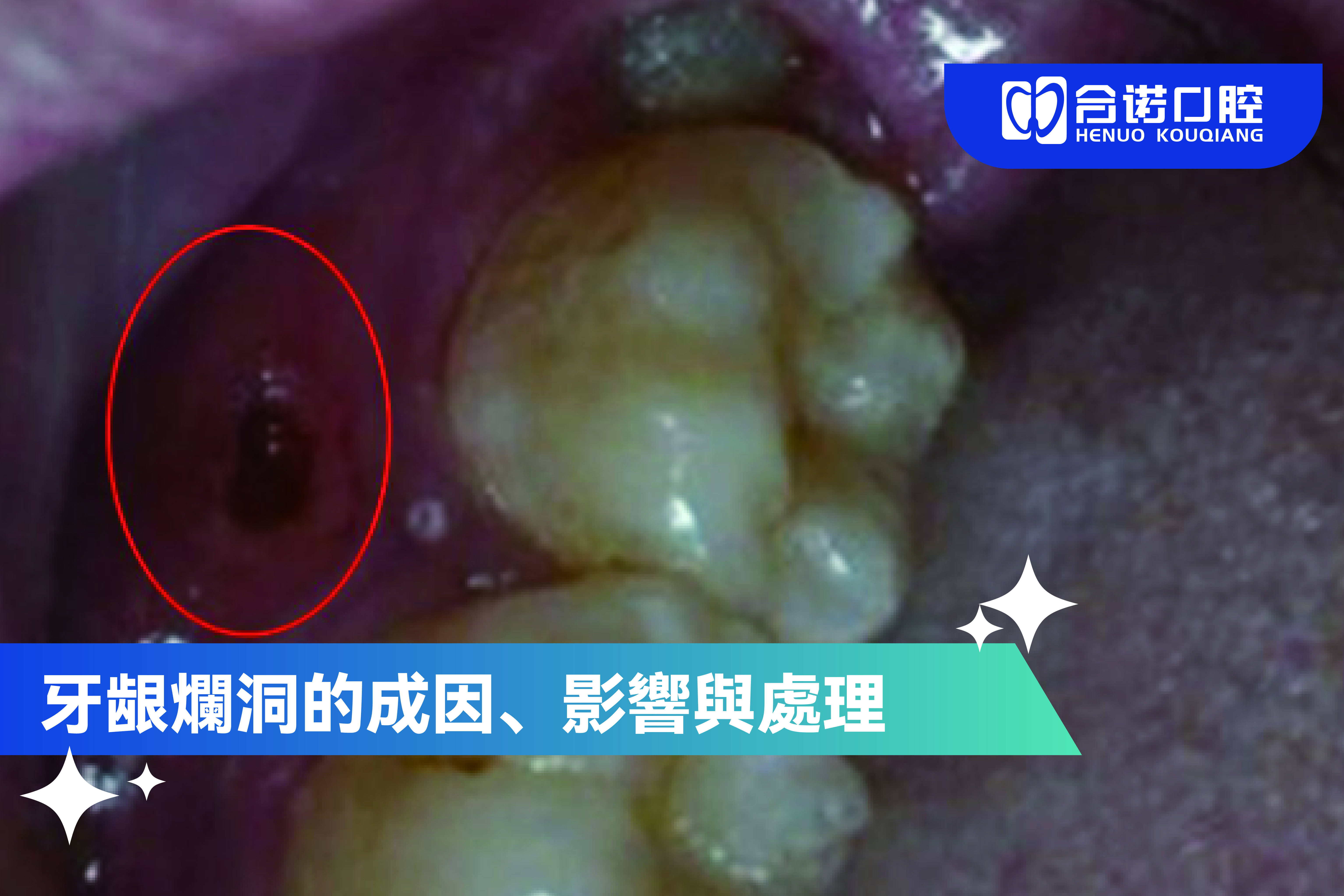 ​牙龈爛洞的成因、影響與處理方法詳解